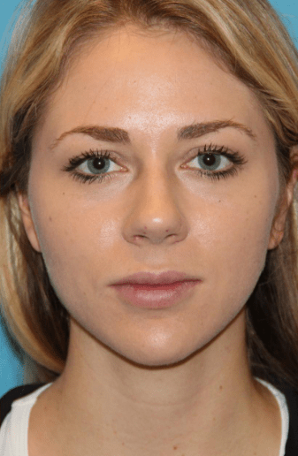 Slimmer Jawline after treatment